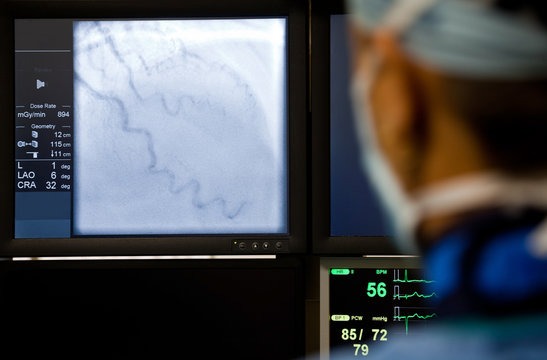 Coronary Angiogram