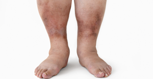 Feet and lower legs with uneven skin tone, redness, and visible varicose veins or venous changes.