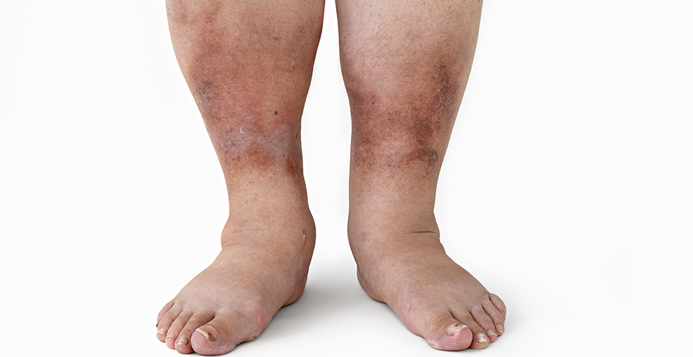 Feet and lower legs with uneven skin tone, redness, and visible varicose veins or venous changes.